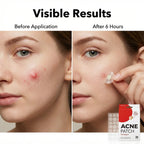 Acne Patches