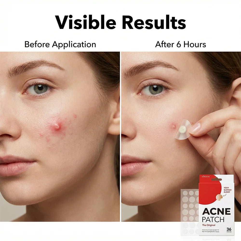 Acne Patches